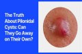Can girls get pilonidal cyst