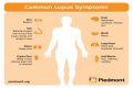 What helps a lupus flare up?